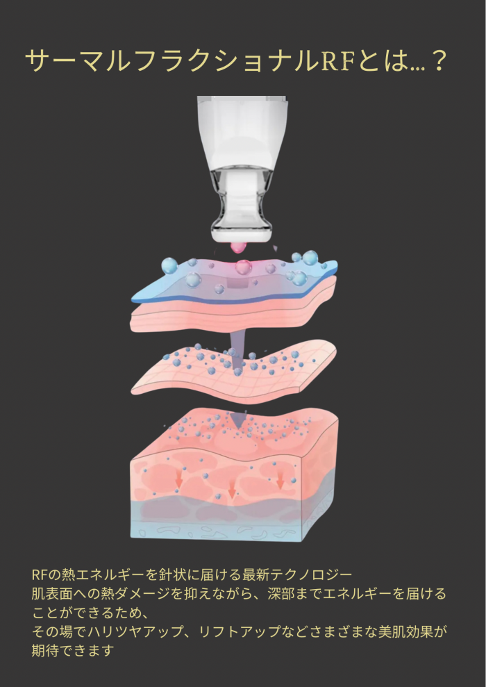 フラクショナルRF Onyx-オニキス-